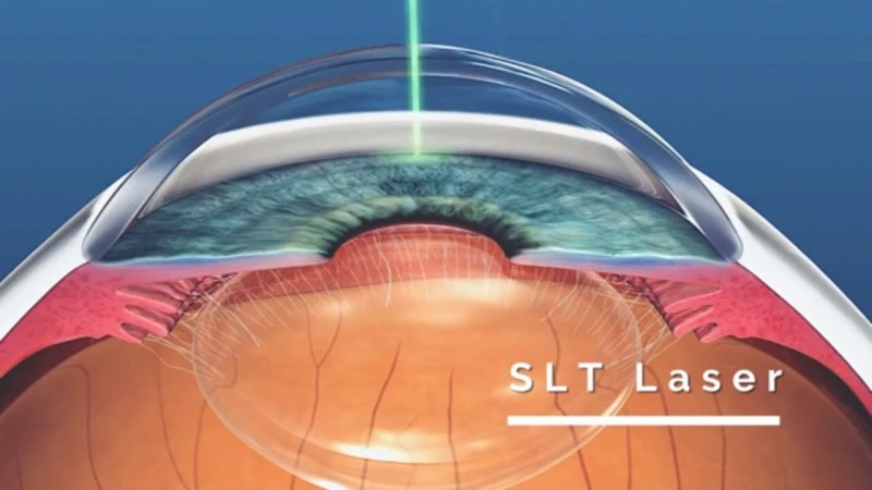 Laser SLT substitui colírios no tratamento do glaucoma | Alerta Paraná